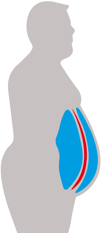 viszeralfett,Bauch,Übergewicht,Gefahr,Achtung,Ernährung,Abnehmen,hilfe,Lebens-Retter